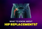 What to know about hip replacements?