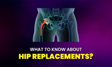 What to know about hip replacements?